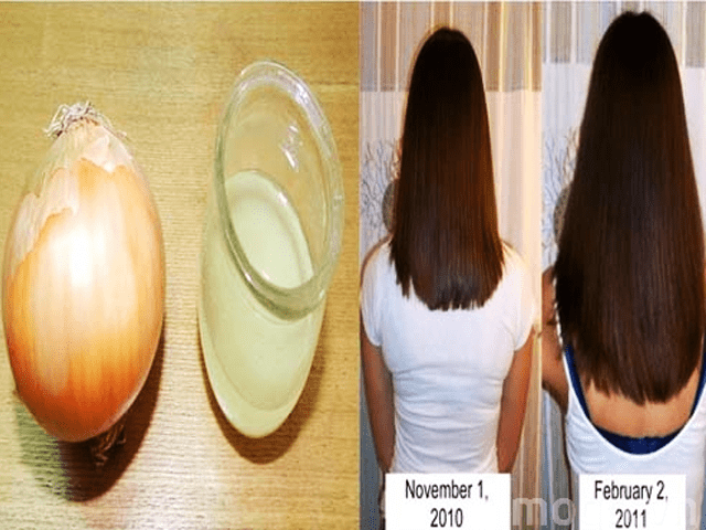 Bật mí 12 công thức kết hợp với hành tây giúp kích thích mọc tóc - dài tóc