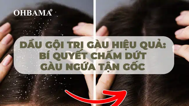 Dầu gội trị gàu hiệu quả- Bí quyết chấm dứt gàu ngứa tận gốc