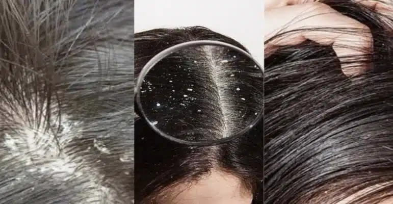Những nguyên nhân phổ biến gây ra gàu
