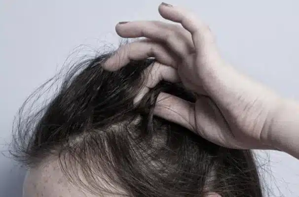 Nhổ tóc bạc, tóc sâu có hết ngứa?
